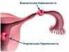 Опасность внематочной беременности